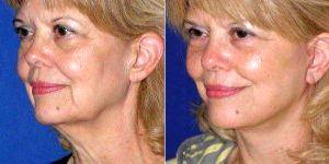 58 Year Old Woman Treated With Facelift With Dr. Stanley W. Jacobs, MD, San Francisco Facial Plastic Surgeon