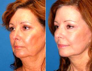 59 Year Old Female Patient Facelift By Dr Ross A. Clevens, MD, Melbourne Facial Plastic Surgeon