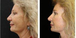 59 Year Old Woman Treated With Facelift Before And After By Dr. Roger Tsai, MD, Beverly Hills Plastic Surgeon