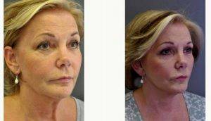 59 Year Old Woman Treated With Facelift Before And After With Dr. Marc Pacifico, MD, FRCS(Plast), London Plastic Surgeon