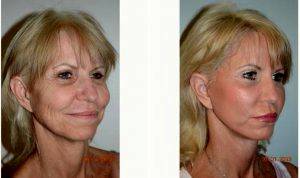 59 Year Old Woman Treated With Facelift By Dr Walton Montegut, MD, Newport Beach Physician
