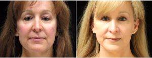 59 Year Old Woman Treated With Facelift With Doctor Mark Anton, MD, FACS, Newport Beach Plastic Surgeon