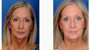 59 Year Old Woman Treated With Facelift With Dr Wayne F. Larrabee, MD, Seattle Facial Plastic Surgeon