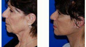 60 Year Old Woman Treated With Facelift Before And After With Dr Anand G. Shah, MD, San Antonio Facial Plastic Surgeon