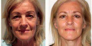 60 Year Old Woman Treated With Facelift By Doctor Damien Grinsell, MBBS, FRACS (Plas), Melbourne Plastic Surgeon
