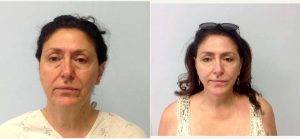 60 Year Old Woman Treated With Facelift By Doctor Ron Soltero, MD, San Diego Plastic Surgeon
