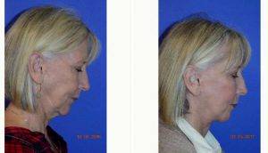 60 Year Old Woman Treated With Facelift With Doctor Walton Montegut, MD, Newport Beach Physician