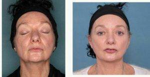 61 Year Old Woman Treated With Face And Neck Lift in Melbourne