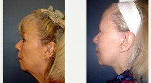61 Year Old Woman Treated With Facelift And Liposuction By Dr Neena Will, MD, Chicago Facial Plastic Surgeon