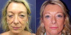 61 Year Old Woman Treated With Facelift Before And After By Dr Yannis Alexandrides, MD, London Plastic Surgeon