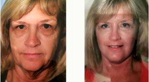 61 Year Old Woman Treated With Facelift With Upper And Lower Lids With Dr. Steven H. Wiener, MD, Scottsdale Plastic Surgeon
