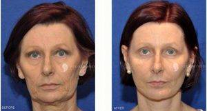62 Year Old Woman Treated With Facelift Before And After By Dr Warwick Nettle, MBBS, FRACS, Sydney Plastic Surgeon