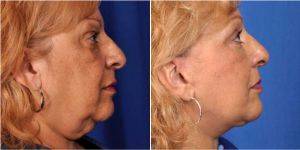 62 Year Old Woman Treated With Facelift, Open Necklift, Endoscopic Browlift, Upper And Lower Eyelids By Dr. Peter D. Geldner, MD, Chicago Plastic Surgeon