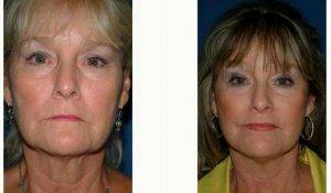 62 Year Old Woman Treated With Facelift With Doctor Donald Wortham, MD, Seattle Facial Plastic Surgeon