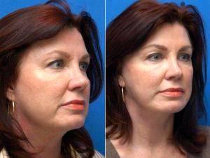 62 Year-old Female Facelift Before And After With Doctor David N. Sayah, MD, FACS, Beverly Hills Plastic Surgeon