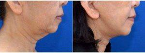 63 Year Old Woman Treated With Facelift Before And After By Dr. Justin Yovino, MD, FACS, Beverly Hills Plastic Surgeon