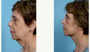 63 Year Old Woman Treated With Facelift By Doctor Thomas A. Mustoe, MD, FACS, Chicago Plastic Surgeon