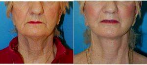 64-74 Year Old Woman Treated With Facelift By Dr. Sharon Y. Giese, MD, New York Plastic Surgeon
