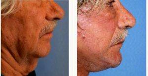 65 Year Old Man Treated With Facelift By Dr H. George Brennan, MD, FACS, Newport Beach Facial Plastic Surgeon