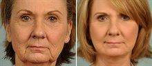 66 Year Old Female Facelift With Dr. Christine A. Petti, MD, Los Angeles Plastic Surgeon