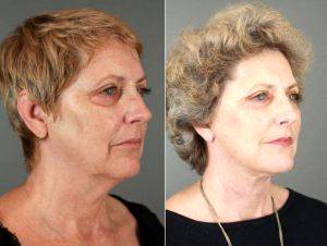 66 Year Old Woman Treated With Facelift By Doctor Patti A. Flint, MD, Scottsdale Plastic Surgeon