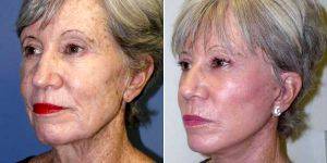 67 Year Old Woman Treated With Facelift Before And After With Doctor Ritu Chopra, MD, Beverly Hills Plastic Surgeon