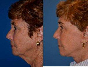 67 Yr Old Female Face Lift Patient With Dr Ross A. Clevens, MD, Melbourne Facial Plastic Surgeon