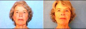 68 Year Old Woman Treated For Facelift With Dr. James C. Pietraszek, MD, San Diego Plastic Surgeon
