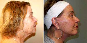 70 Year Old Woman Treated With Facelift Before And After With Doctor Michael Baumholtz, MD, San Antonio Plastic Surgeon