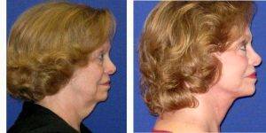 70 Year Old Woman Treated With Facelift With Doctor Gustavo A. Diaz, MD, Charlotte Facial Plastic Surgeon