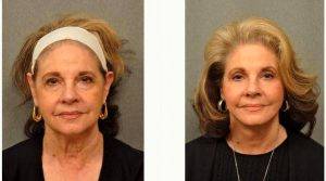 70 Year Old Woman Treated With Facelift With Dr Gilbert Lee, MD, San Diego Plastic Surgeon
