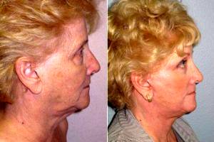 75 Year Old Facial Plastic Surgery Patient From Temecula Before And After With Doctor Stuart B. Kincaid, MD, FACS , Beverly Hills Plastic Surgeon