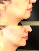 A Facelift Can Produce Remarkable Results