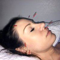 Acupuncture Facelift Massachusetts