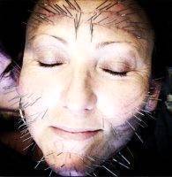 Acupuncture Facelift Melbourne Images