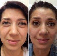 BOTOX Cosmetic To Reduce The Appearance Of Fine Lines