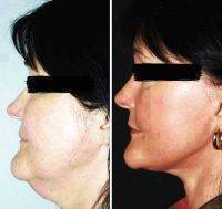Beautiful Lower Facelift Results