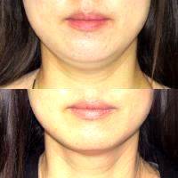 Before And After Coolsculpting Mini For The Submental Or Chin Fat