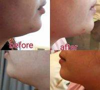 Before And After Photos Of One Stitch Facelift (1)