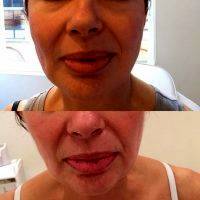 Before And After Photos Of One Stitch Facelift (10)