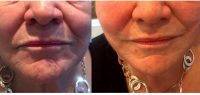 Before And After Photos Of One Stitch Facelift (11)