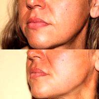 Before And After Photos Of One Stitch Facelift (13)