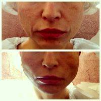 Before And After Photos Of One Stitch Facelift (2)