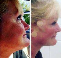 Before And After Photos Of One Stitch Facelift (3)