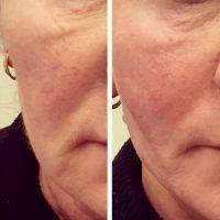 Before And After Photos Of One Stitch Facelift (4)
