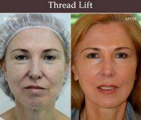 Before And After Photos Of One Stitch Facelift (5)