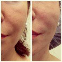Before And After Photos Of One Stitch Facelift (6)