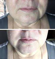Before And After Photos Of One Stitch Facelift (7)