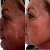 Before And After Surgical Removal Of Wrinkles