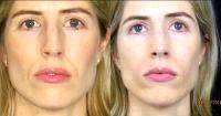 Botox Facelift In London Before And After